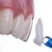 установка виниров для решения проблемы крошения зубов